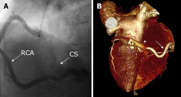 Коронарная фистула