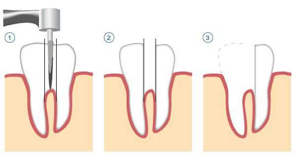 Удаление корня целиком