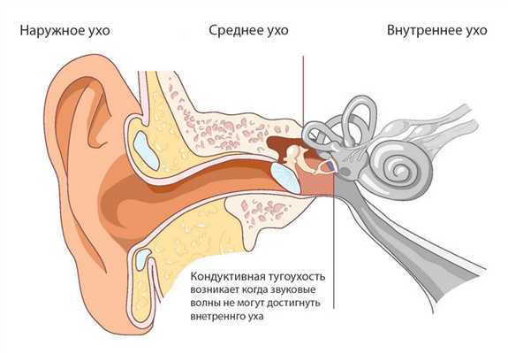 Кондуктивная тугоухость