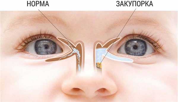 Дакриоцистит у новорожденных
