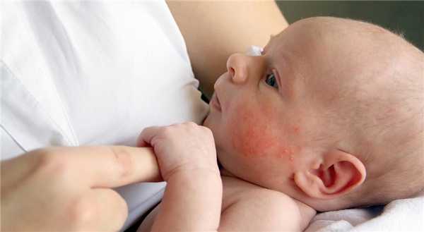 аллергия у новорожденного