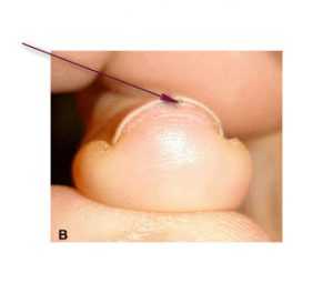 Рис. 2. Красная полоса в толще ногтя