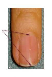 Рис. 1. Красная полоса на ногтевой пластине