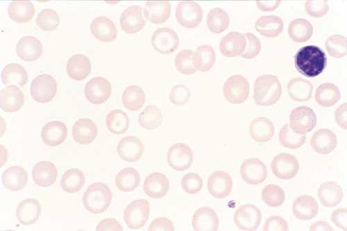 Апластическая анемия