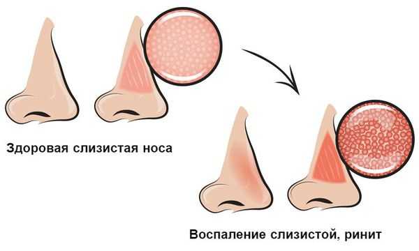 Воспаление слизистой носа