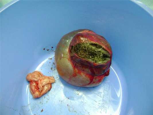 Удаленная опухоль