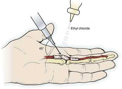 Местная инъекция в области сухожилий сгибателей.