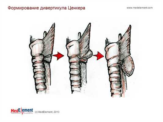 Дивертикул Ценкера