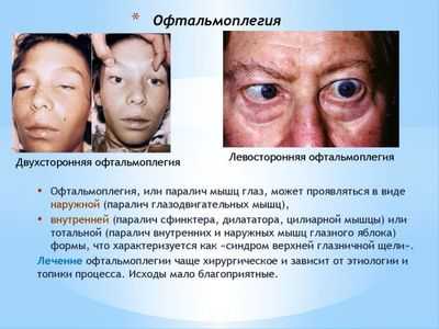 наружная и внутренняя офтальмоплегия