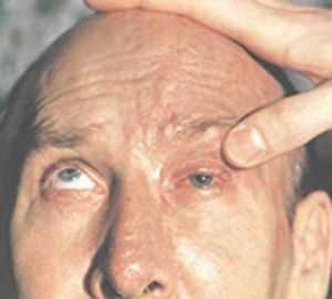 симптомы офтальмоплегии