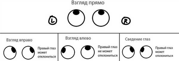 расстройство синхронного движения глазных яблок