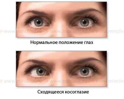 Показано нормальное положение глазных яблок и сходящееся косоглазие при слабости латеральной (наружной) прямой мышцы глаза справа (VI пара черепно-мозговых нервов).