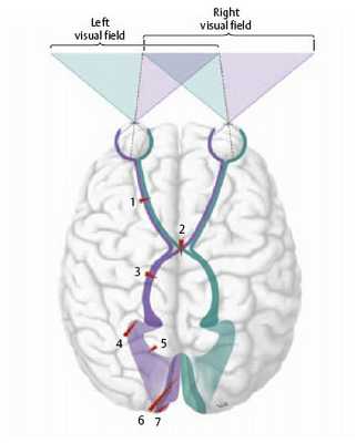 Дефекты поля зрения и участки поражения показаны для левого зрительного пути