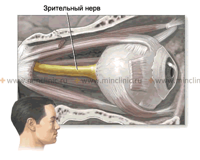 При неврите зрительного нерва воспалительный процесс ретробульбарно поражает его миелиновую оболочку на всем его протяжении — от диска зрительного нерва до перекрёстка зрительных нервов (хиазмы).
