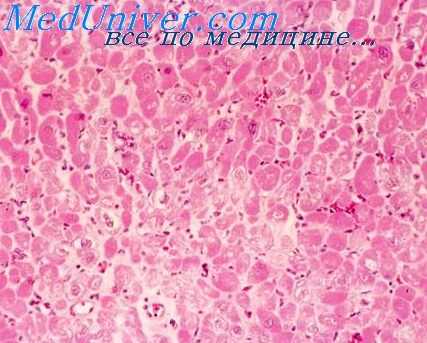 лучевая болезнь