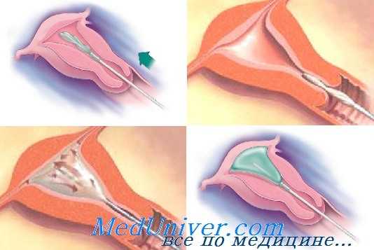 техника абляции эндометрия