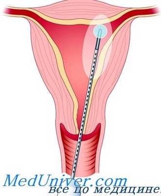методы абляции эндометрии