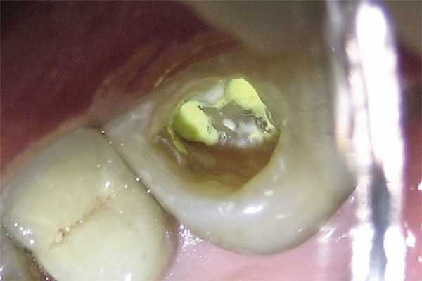 Рис. 5. Глубокая полость требует изолирующей прокладки.