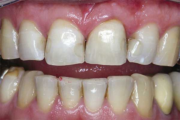 Рис. 1. Пигментация при нарушении краевого прилегания.