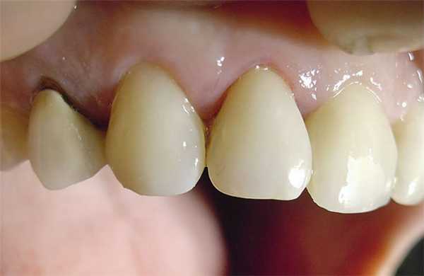 Рис. 7б. Качественное реставрирование латерального резца.