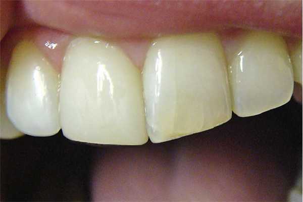 Рис. 3. Трещины эмали.