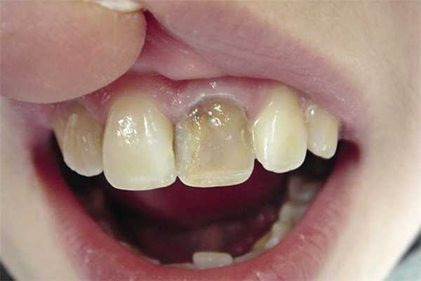 Рис. 2. Пигментация депульпированного зуба.