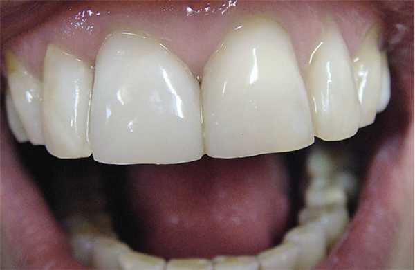 Рис. 8а. Качественное реставрирование центрального резца.