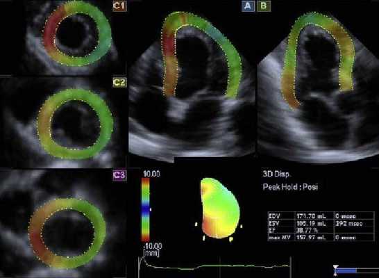 Фракция сердечного выброса на УЗИ