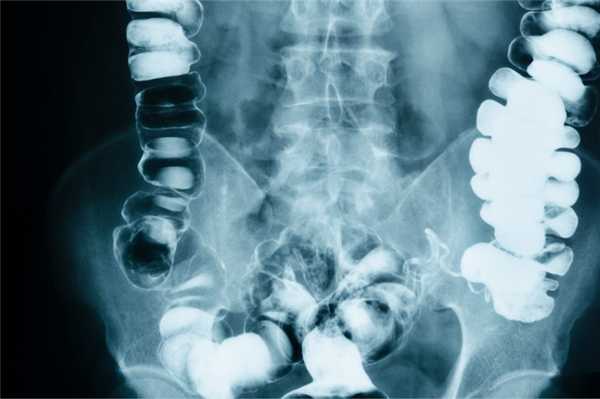 Непроходимость кишечника на снимке