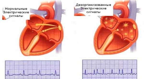 Мерцательная аритмия сердца