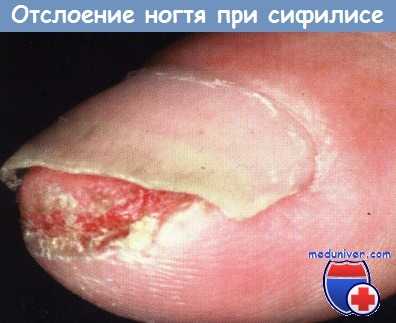 Онихолизис (отслоение ногтя) при сифилисе