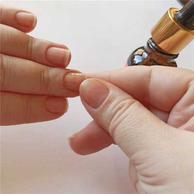 лечение онихолизиса препараты против онихолизиса.jpg