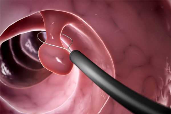 Папилломы гортани