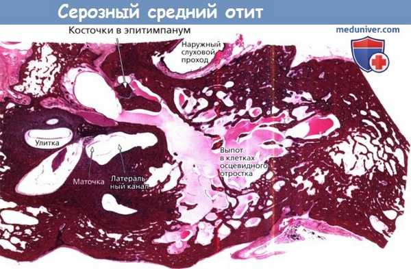 Серозный средний отит