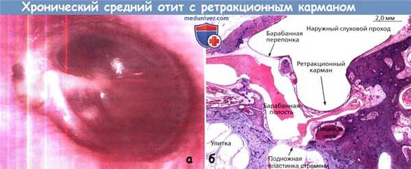 Хронический средний отит с ретракционным карманом