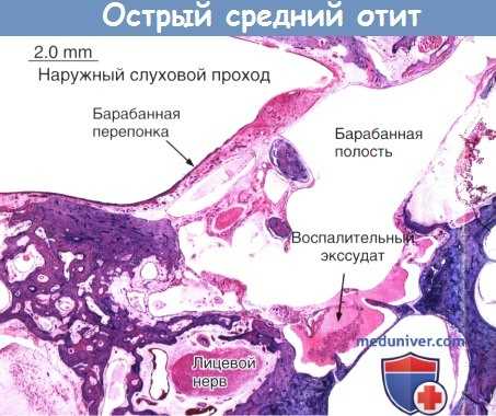 Патогенез острого среднего отита