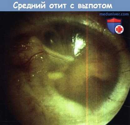 Средний отит с выпотом