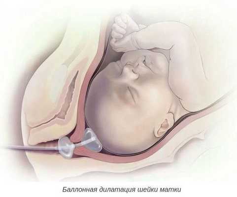 Баллонная дилатация шейки матки