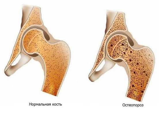Остеопороз