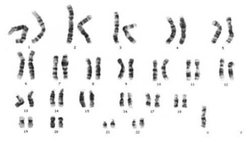 кариотип при синдроме Тернера