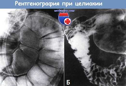 Рентгенография при целиакии
