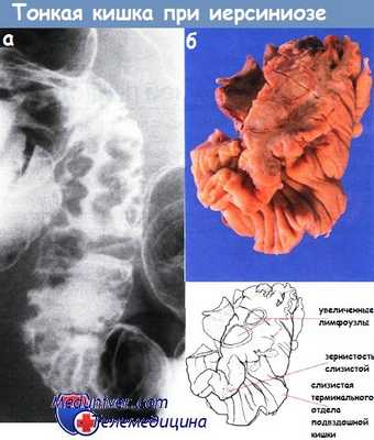 Тонкая кишка при иерсиниозе