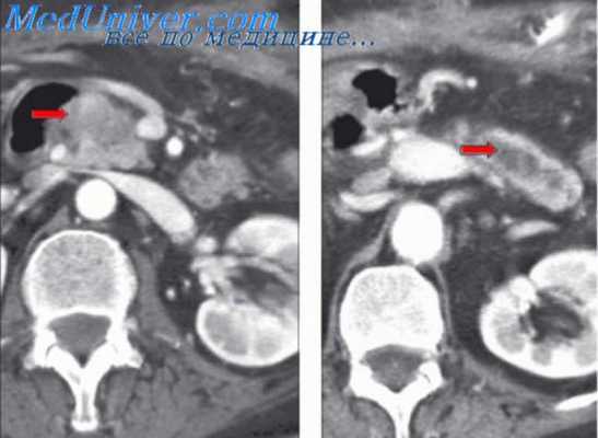 портальная гипертензия