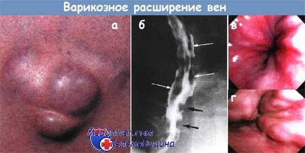 Варикозное расширение вен при циррозе печени