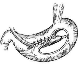свищ желудка