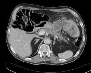 Желудочно-ободочный свищ 