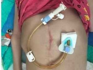 гастростома свищ желудка