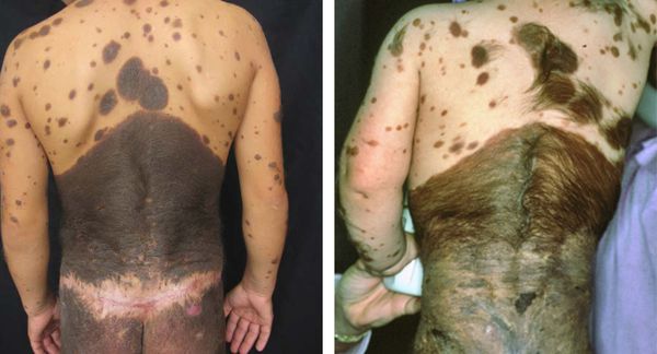 Гигантские невусы