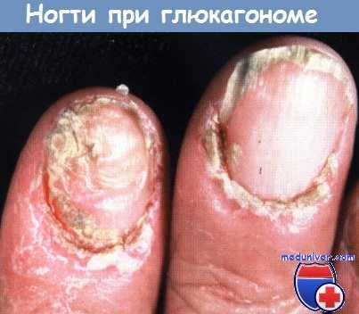 Ногти при глюкагономе