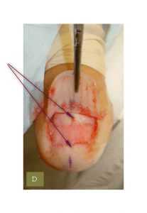Рис. 4. При поднятии ногтевой пластины видная красная полоса на ногтевом ложе